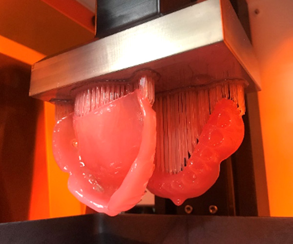 3Dプリンターによる義歯床部分の作製