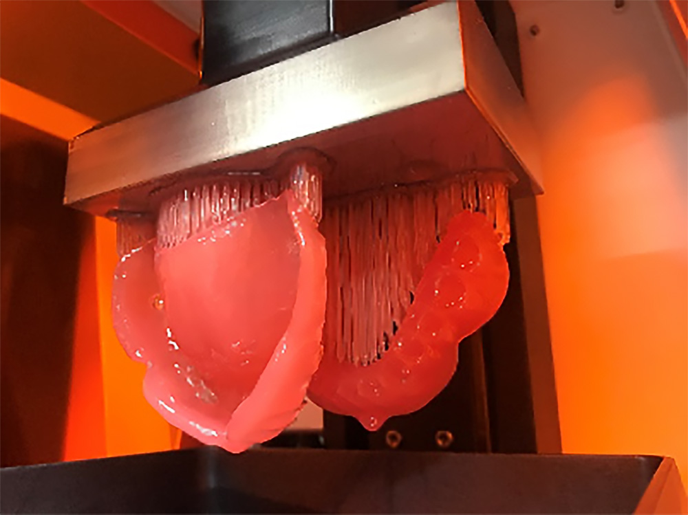 クルツァージャパンの歯科用3Dプリント事業