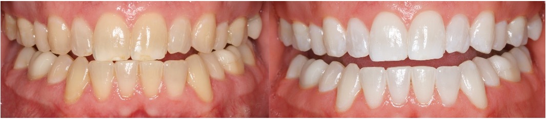 Ultradent社製品を使用した治療イメージ図